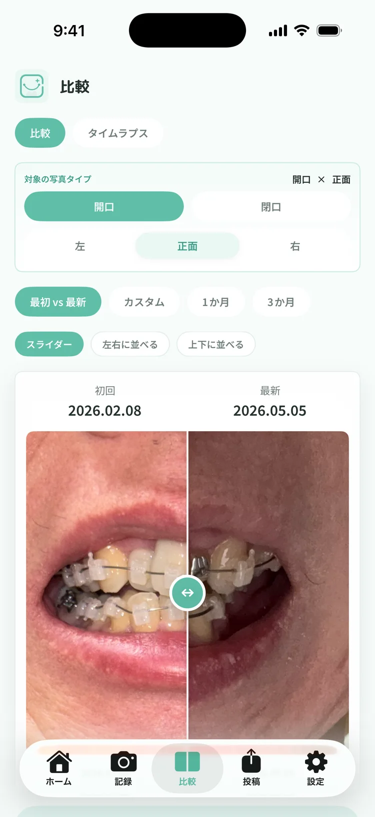 矯正ログ / SmileProgress